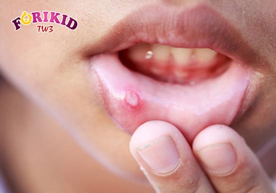 Nhiệt miệng là một dấu hiệu thường thấy ở trẻ bị nóng trong