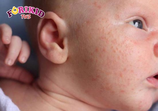 Trẻ bị nóng trong mẩn ngứa là loại bệnh xảy ra rất phổ biến đối với trẻ nhỏ.