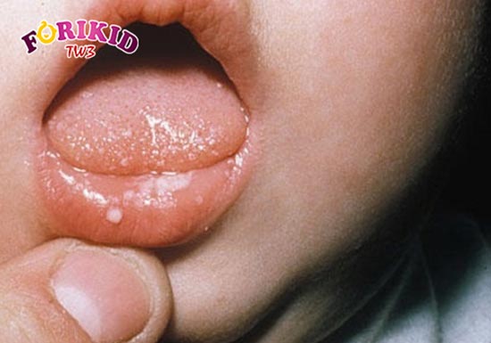Thể nhiệt miệng herpetiform được tạo thành từ nhiều vết loét có kích thước nhỏ
