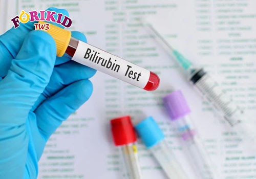Cần kiểm tra nồng độ Bilirubin trong máu ngay nếu trẻ bị vàng da, nước tiểu vàng do viêm gan